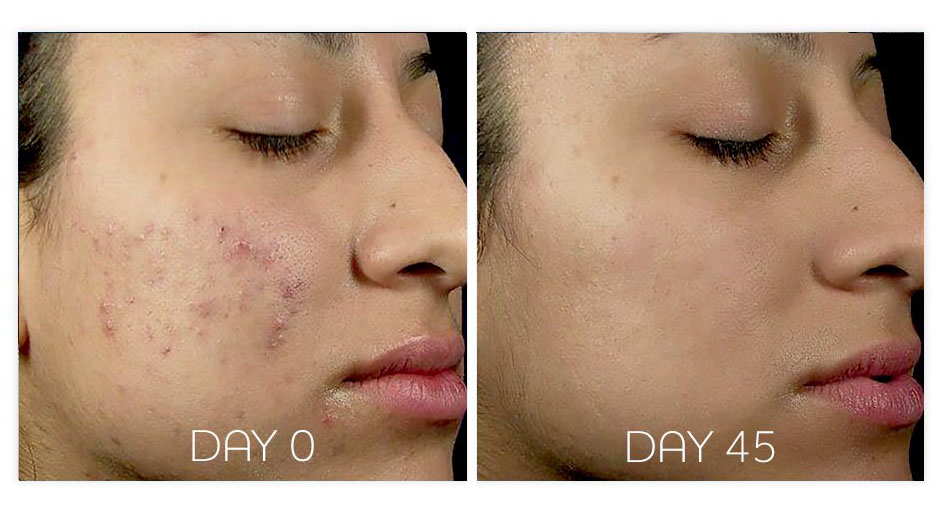Acne Skin - Before and After