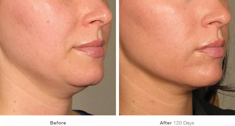 before_after_results_under-chin18