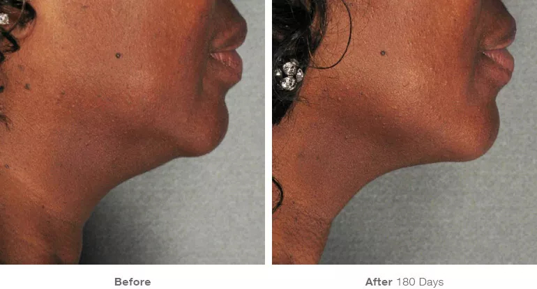 before_after_results_under-chin2