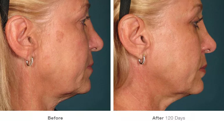 before_after_ultherapy_results_full-face1