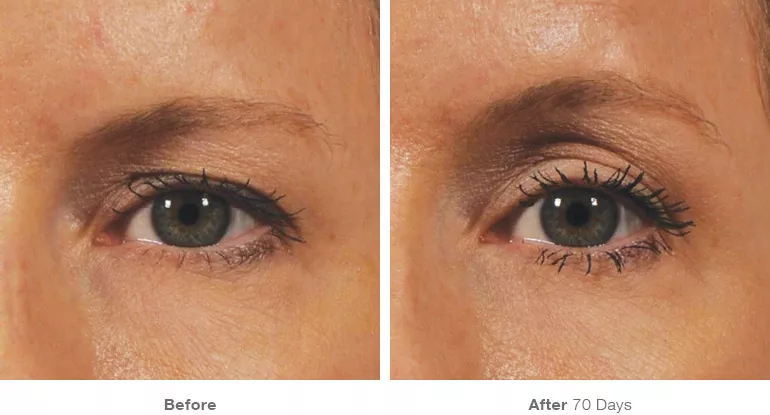 beforeafter_brow12