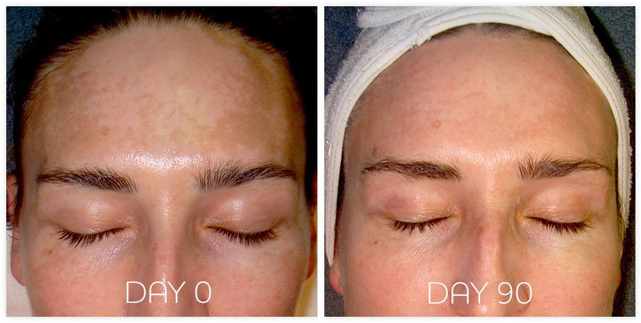 Skin Treatment - Day 0 VS Day 90