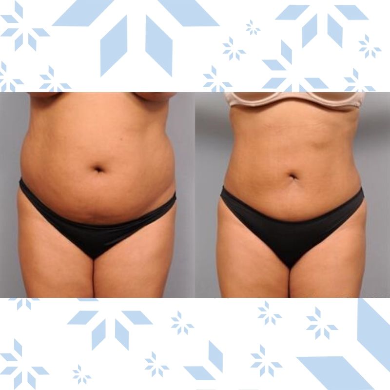 CoolSlimming-Before-and-After-51