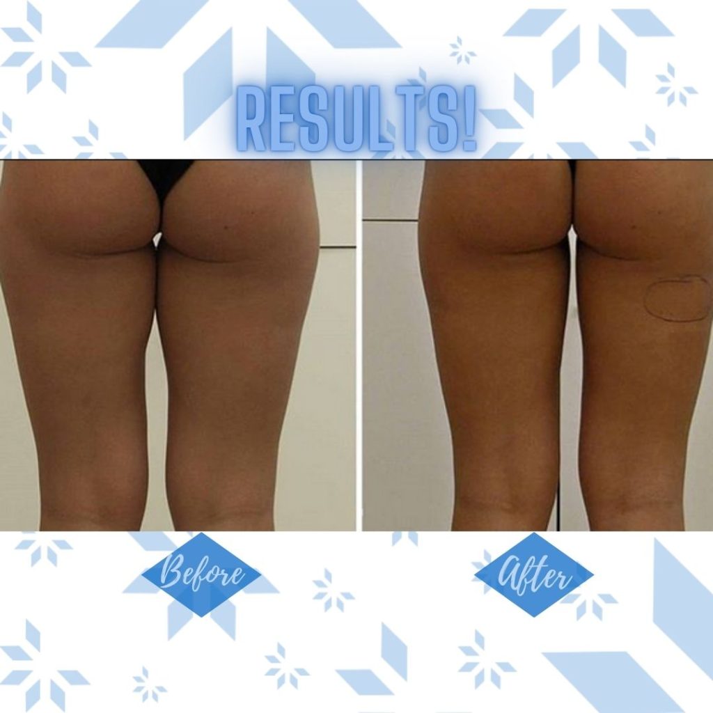 CoolSlimming-Insta-13-1024x1024