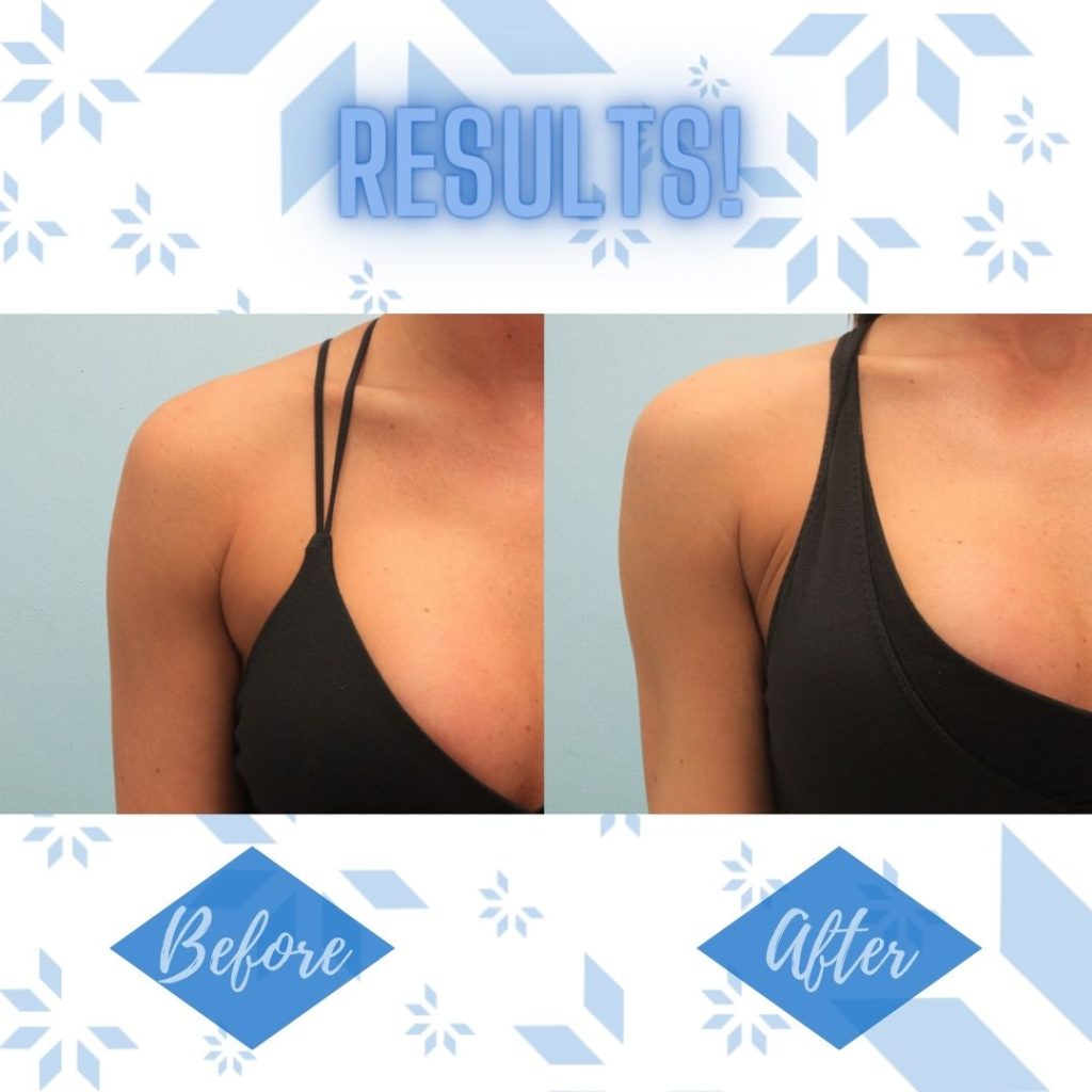 CoolSlimming-cs-18-1024x1024