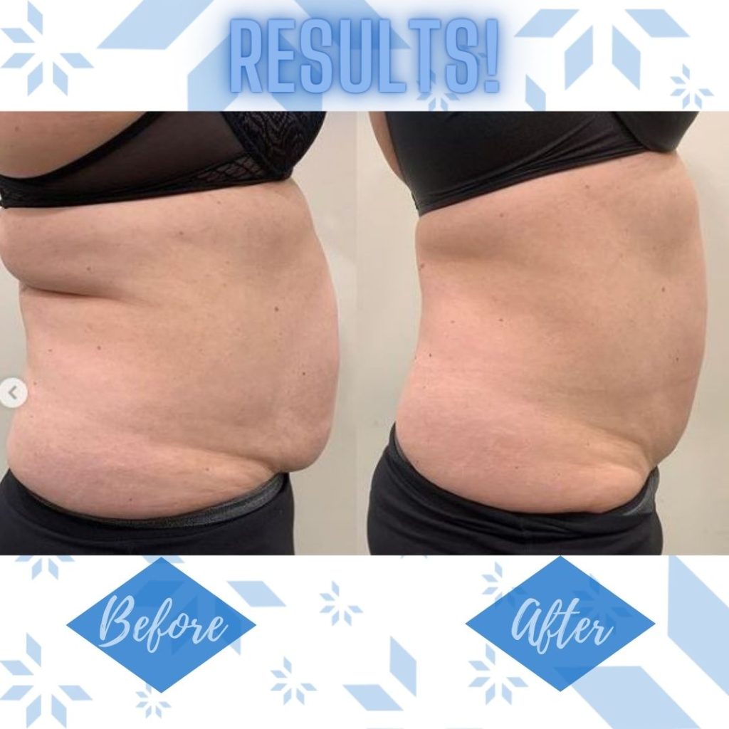 CoolSlimming-cs-21-1024x1024