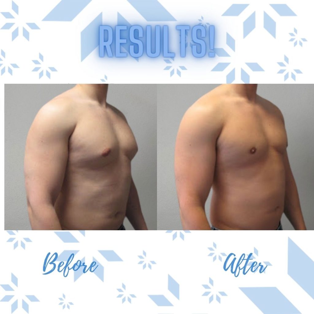 CoolSlimming-cs-33-1024x1024