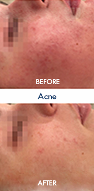 Acne (1)