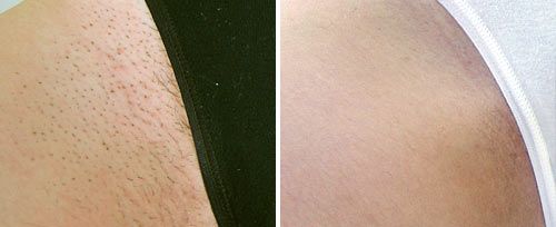 Bikini- B A laser hair removal