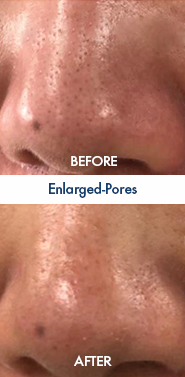 Enlarged-Pores