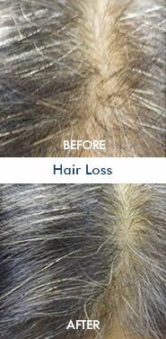 Hair Loss