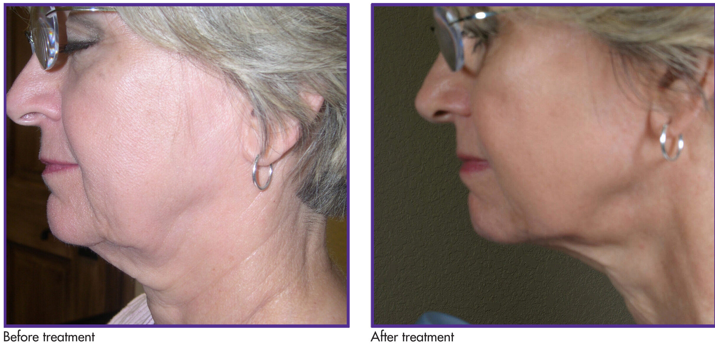 RF before -After face and neck #1