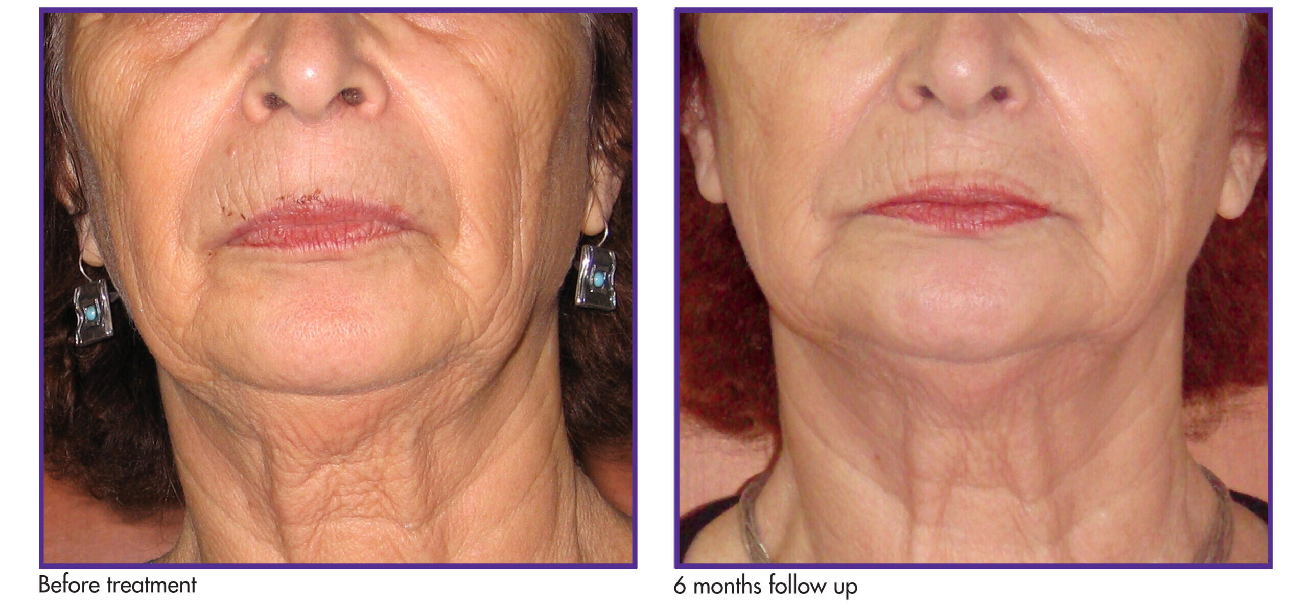 RF before -After face and neck #2