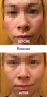 Rosacea