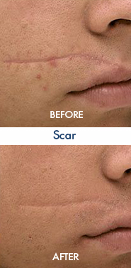 Scar (1)