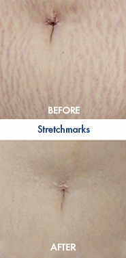 Stretchmarks