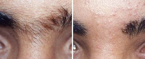 eyebrow_hair_reduction_sult_rn