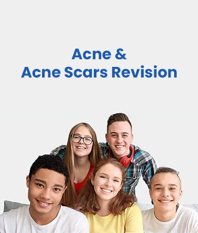 Acne-Mobile-banner